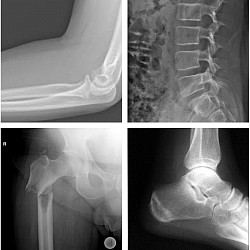 X-ray