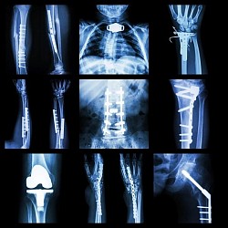 X-ray