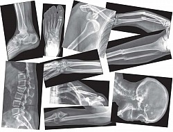 X-ray
