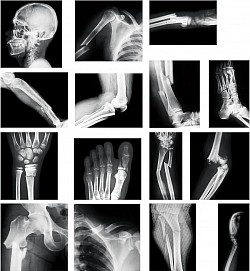 X-ray