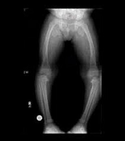 X-ray