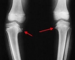 X-ray