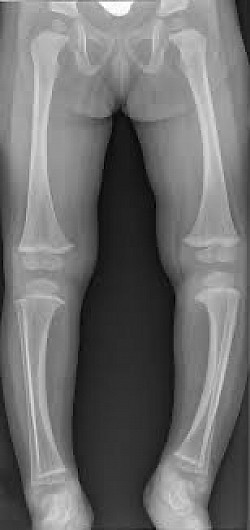 X-ray