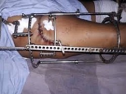 Critical case but healed now