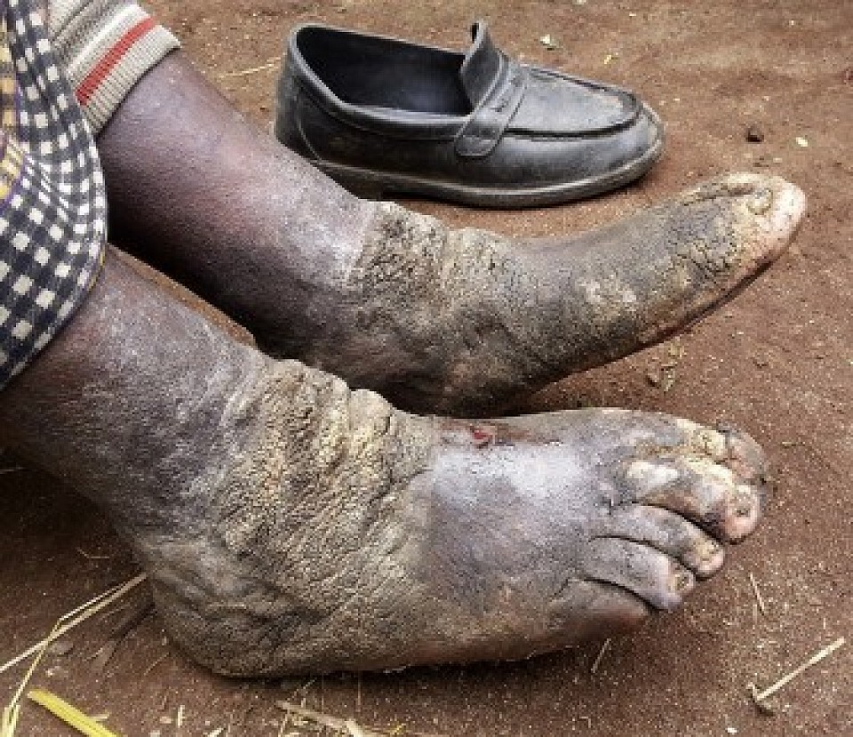 Foot rot patient