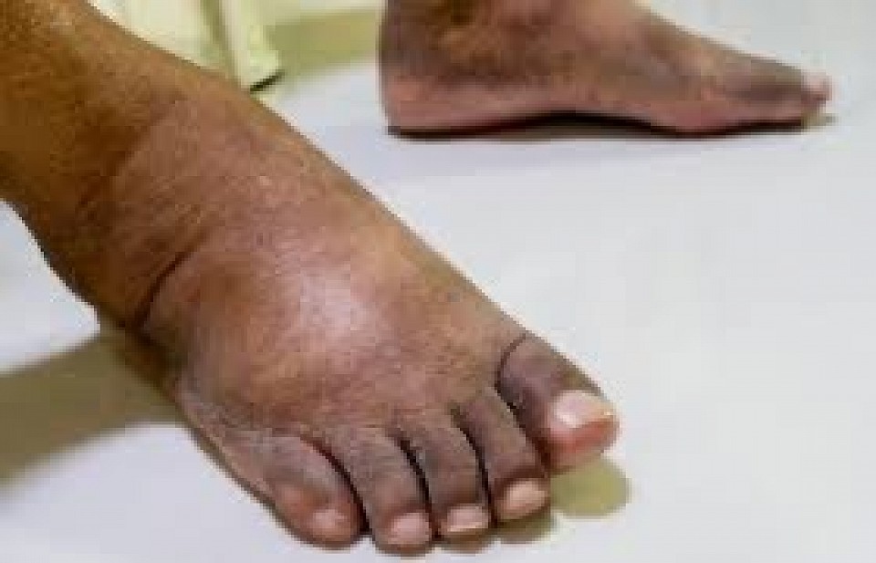 Swollen feet due to diabetes now fully recovered