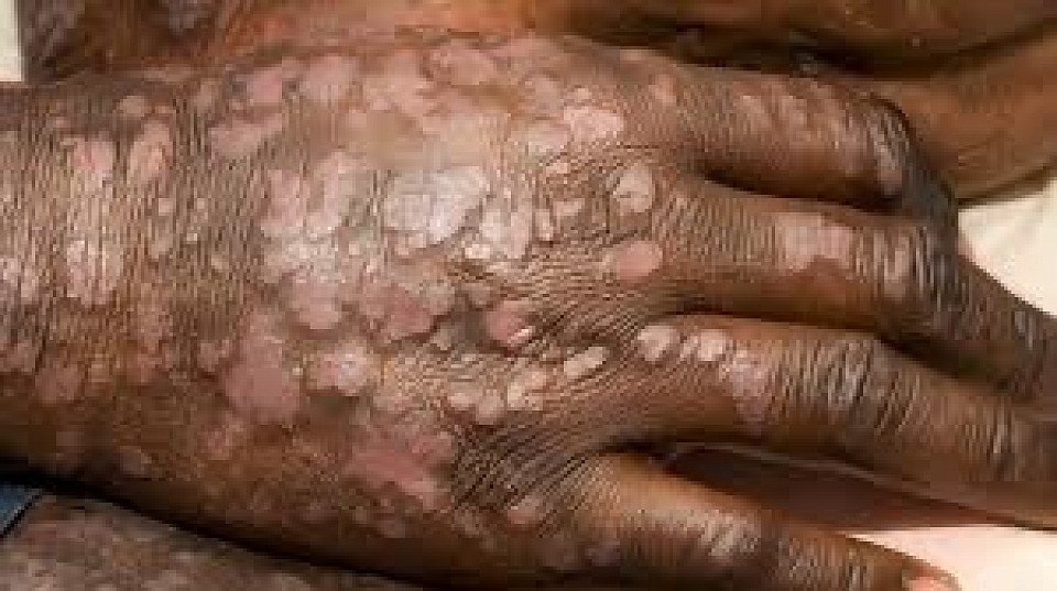 Skin disease patient