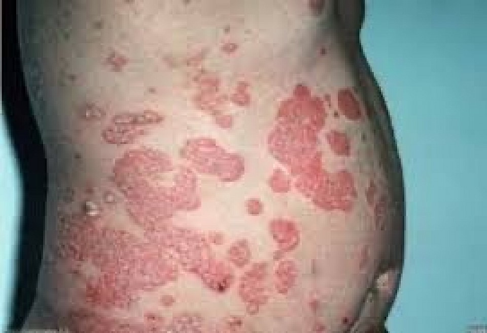 Skin disease